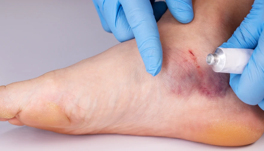 Leading Diabetic Foot Care Clinic in Chennai Diabetic Foot Treatment