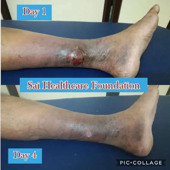 Non Healing Venous Ulcer